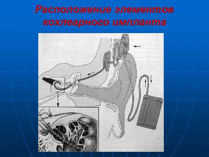 Расположение элементов кохлеарного импланта 