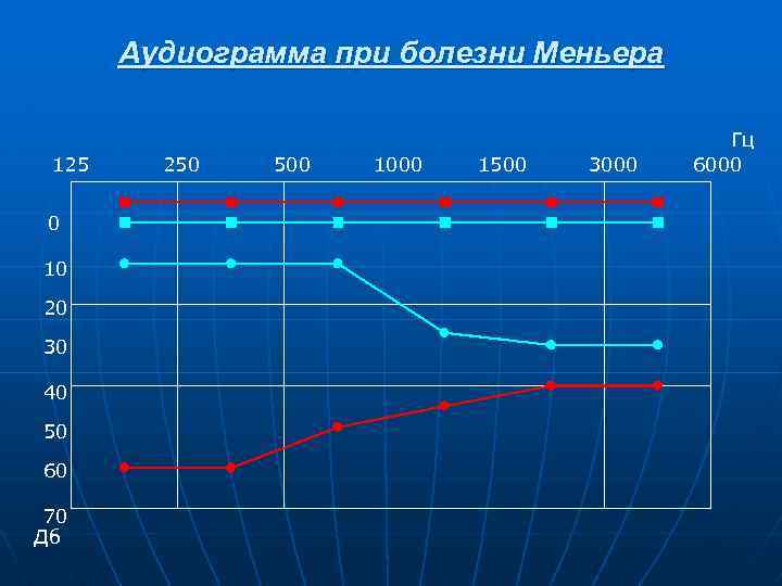 Аудиограмма при болезни Меньера 125 0 10 20 30 40 50 60 70 Дб