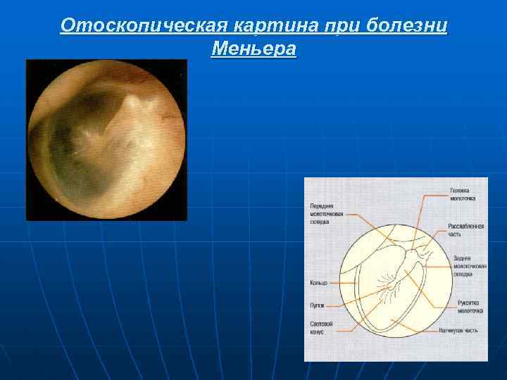 Отоскопическая картина при болезни Меньера 