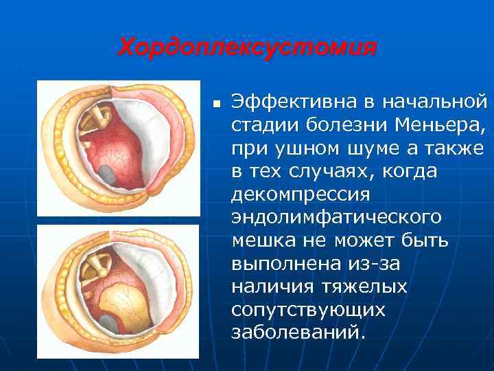 Хордоплексустомия n Эффективна в начальной стадии болезни Меньера, при ушном шуме а также в