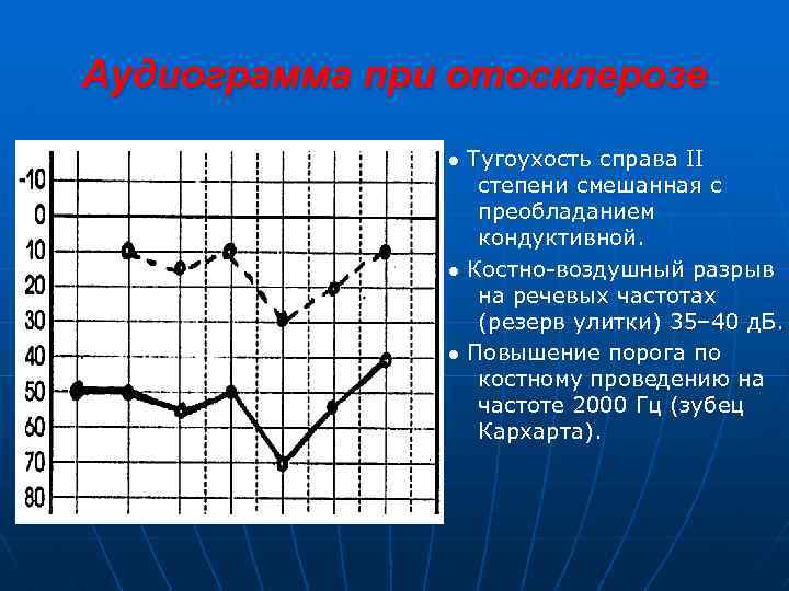 Аудиограмма при отосклерозе ● Тугоухость справа II степени смешанная с преобладанием кондуктивной. ● Костно-воздушный