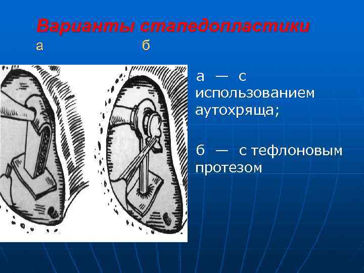 Варианты стапедопластики а б а — с использованием аутохряща; б — с тефлоновым протезом