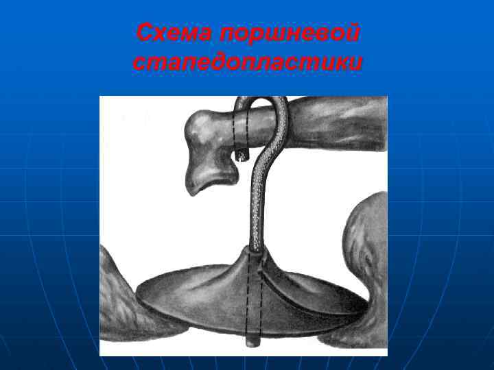 Схема поршневой стапедопластики 