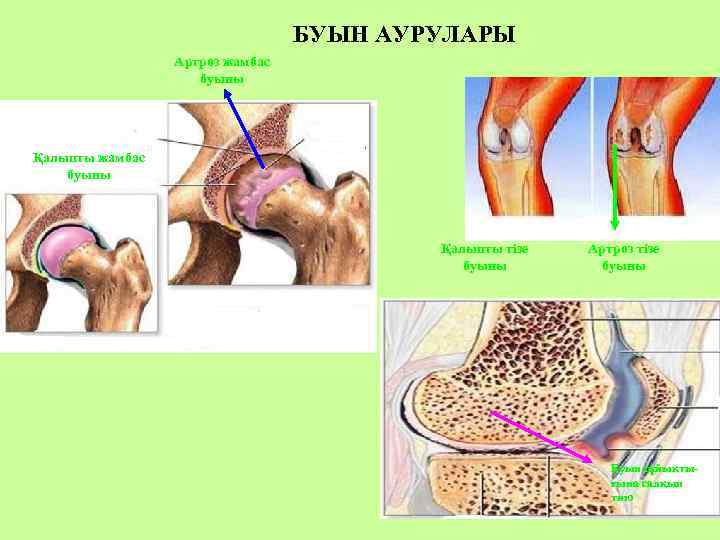 БУЫН АУРУЛАРЫ Артроз жамбас буыны Қалыпты тізе буыны Артроз тізе буыны Буын сұйықтығына салқын