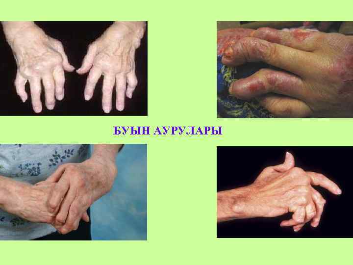 БУЫН АУРУЛАРЫ 