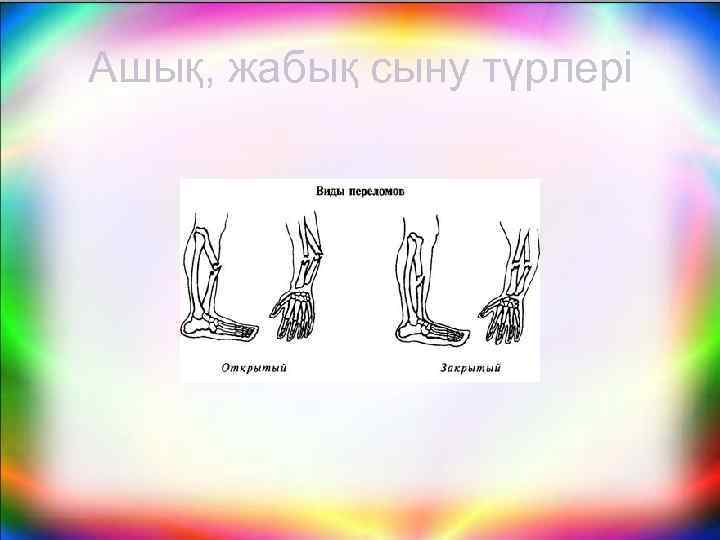 Ашық, жабық сыну түрлері 