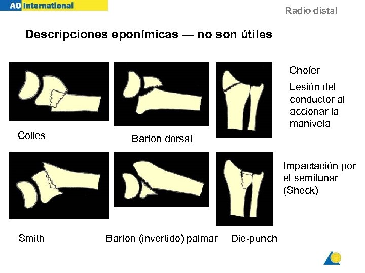 Radio distal Descripciones eponímicas — no son útiles Chofer Lesión del conductor al accionar