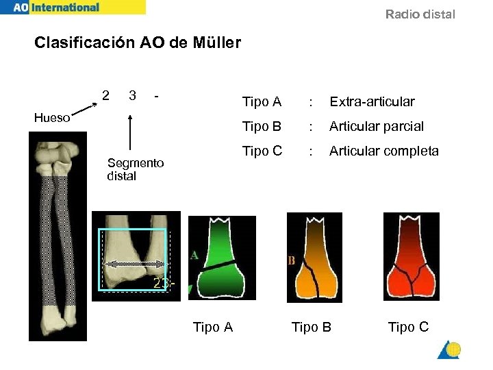 Radio distal Clasificación AO de Müller 2 3 - Tipo A : Articular parcial