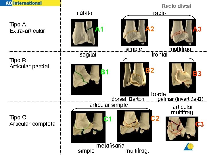 Radio distal cúbito Tipo A Extra-articular Tipo B Articular parcial radio A 2 A