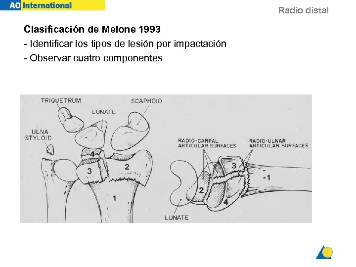 Radio distal Clasificación de Melone 1993 - Identificar los tipos de lesión por impactación