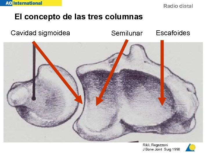 Radio distal El concepto de las tres columnas Cavidad sigmoidea Semilunar Escafoides Rikli, Regazzoni