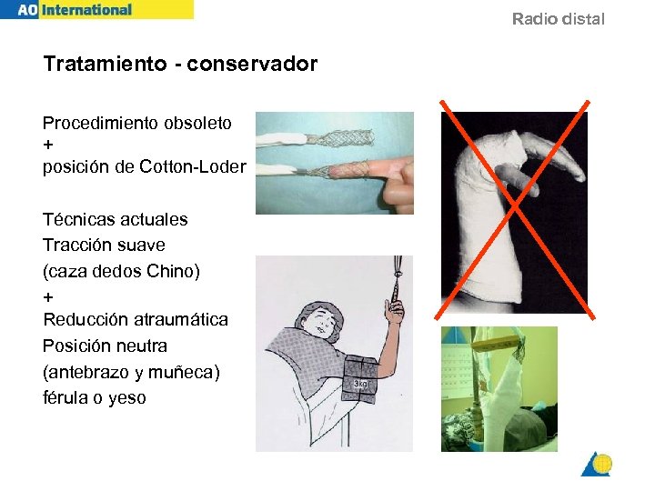 Radio distal Tratamiento - conservador Procedimiento obsoleto + posición de Cotton-Loder Técnicas actuales Tracción