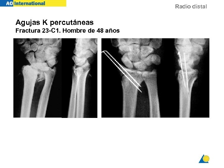 Radio distal Agujas K percutáneas Fractura 23 -C 1. Hombre de 48 años 