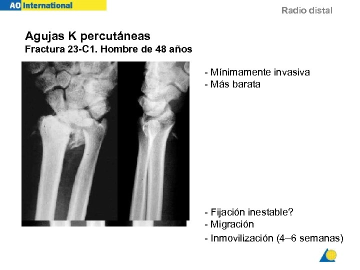 Radio distal Agujas K percutáneas Fractura 23 -C 1. Hombre de 48 años -