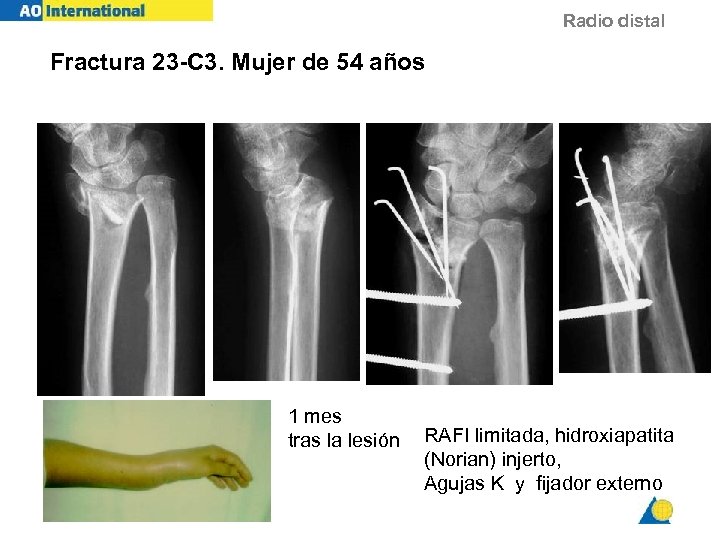 Radio distal Fractura 23 -C 3. Mujer de 54 años 1 mes tras la