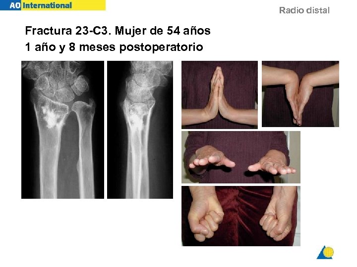 Radio distal Fractura 23 -C 3. Mujer de 54 años 1 año y 8