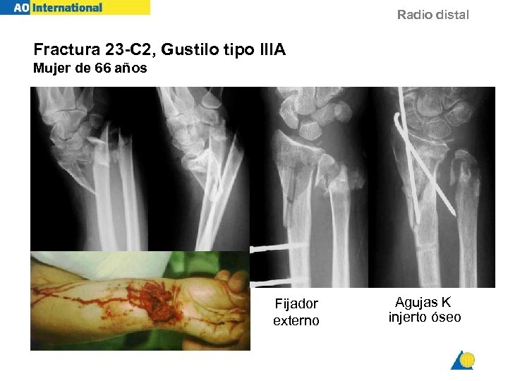 Radio distal Fractura 23 -C 2, Gustilo tipo IIIA Mujer de 66 años Fijador