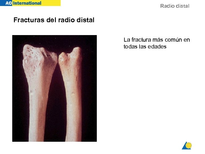 Radio distal Fracturas del radio distal La fractura más común en todas las edades