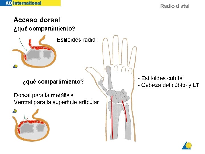 Radio distal Acceso dorsal ¿qué compartimiento? Estiloides radial ¿qué compartimiento? Dorsal para la metáfisis