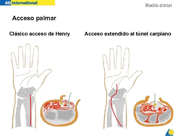 Radio distal Acceso palmar Clásico acceso de Henry Acceso extendido al túnel carpiano 