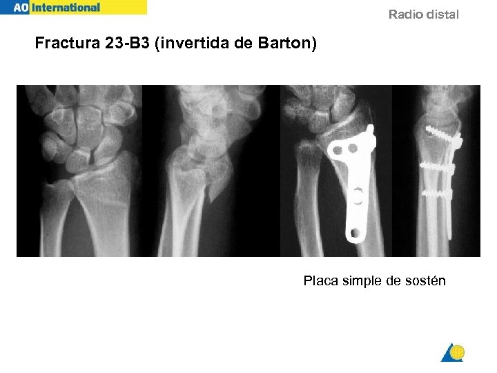 Radio distal Fractura 23 -B 3 (invertida de Barton) Placa simple de sostén 