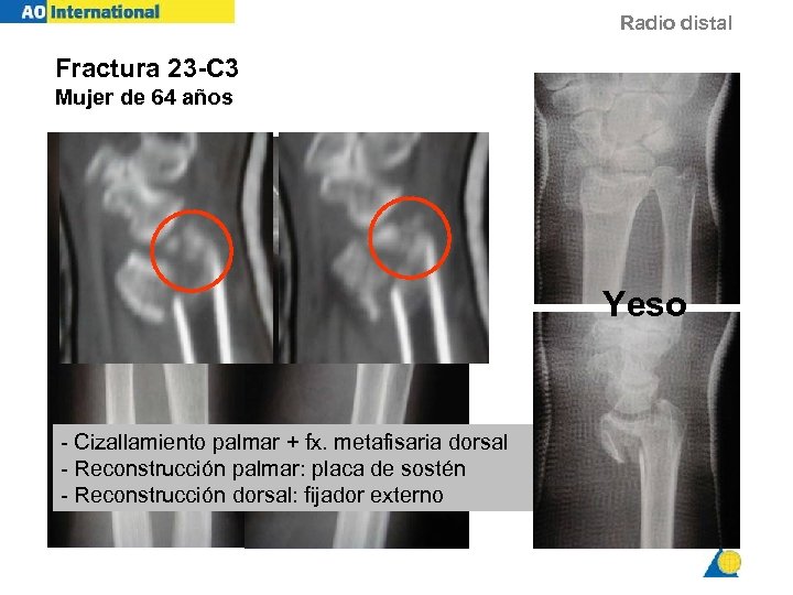 Radio distal Fractura 23 -C 3 Mujer de 64 años Yeso - Cizallamiento palmar