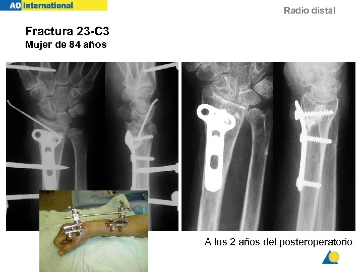 Radio distal Fractura 23 -C 3 Mujer de 84 años A los 2 años