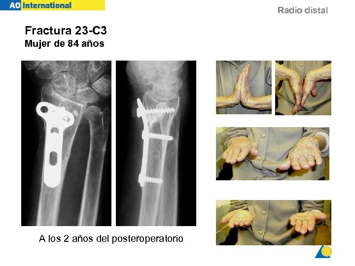 Radio distal TH 84 y f Fractura 23 -C 3 Mujer de 84 años