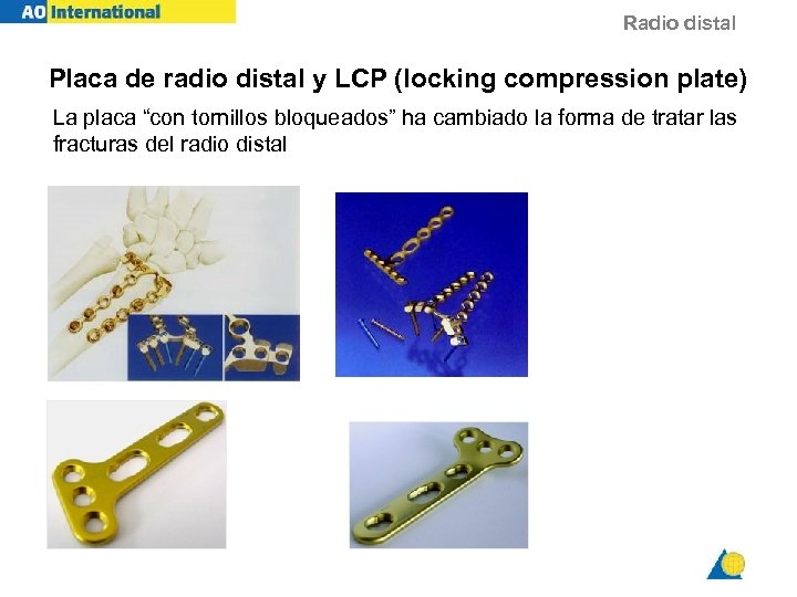 Radio distal Placa de radio distal y LCP (locking compression plate) La placa “con