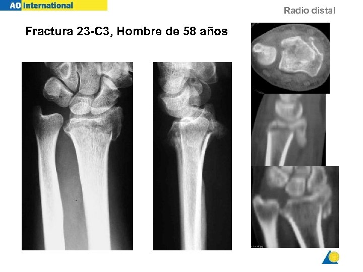 Radio distal Fractura 23 -C 3, Hombre de 58 años 