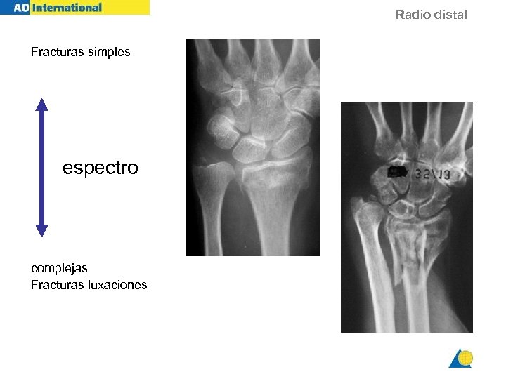 Radio distal Fracturas simples espectro complejas Fracturas luxaciones 