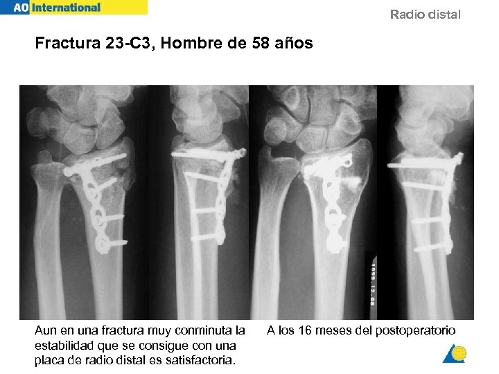 Radio distal Fractura 23 -C 3, Hombre de 58 años Aun en una fractura