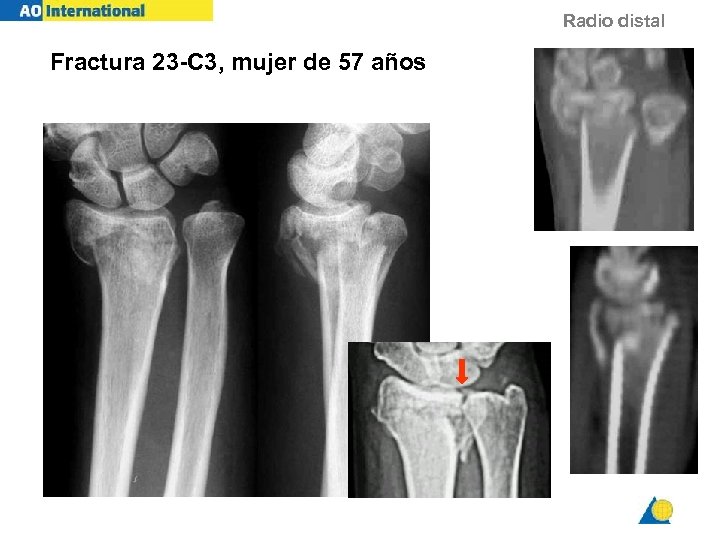 Radio distal Fractura 23 -C 3, mujer de 57 años KF 57 y f