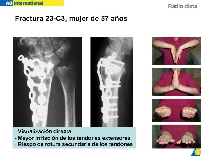 Dorsal approach Fractura 23 -C 3, mujer de 57 años - Visualización directa -