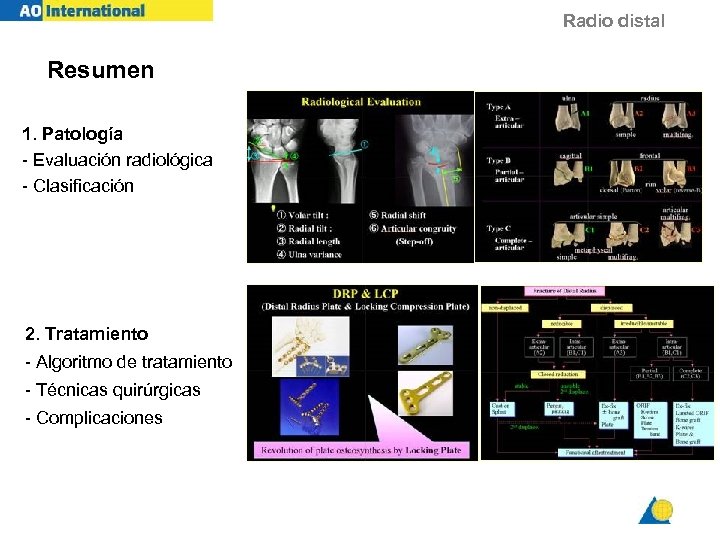 Radio distal Resumen 1. Patología - Evaluación radiológica - Clasificación 2. Tratamiento - Algoritmo