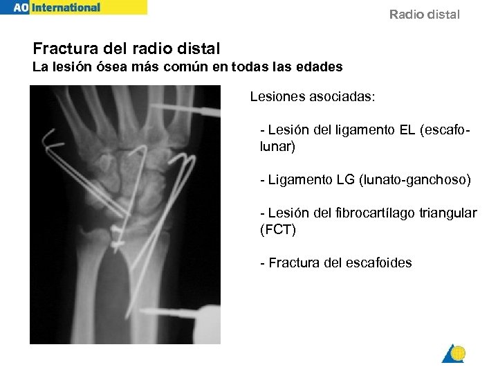 Radio distal Fractura del radio distal La lesión ósea más común en todas las