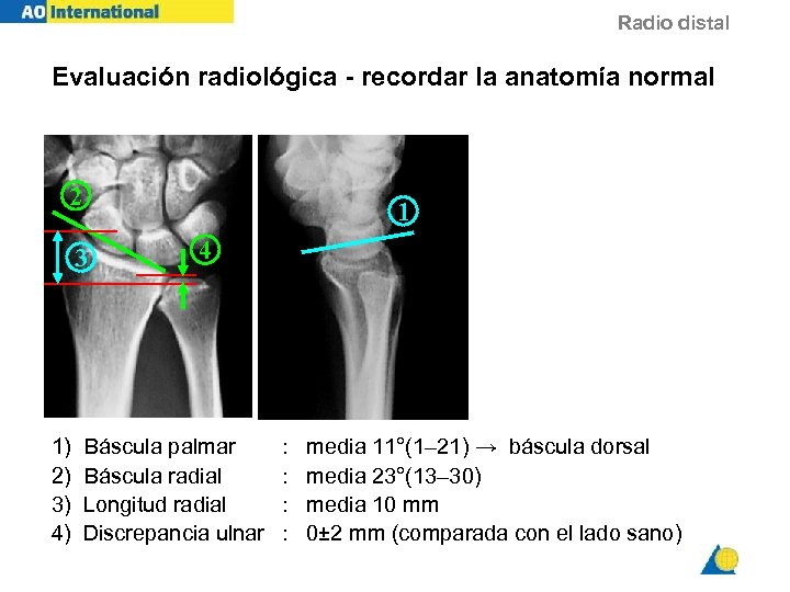 Radio distal Evaluación radiológica - recordar la anatomía normal 2 1 3 1) 2)