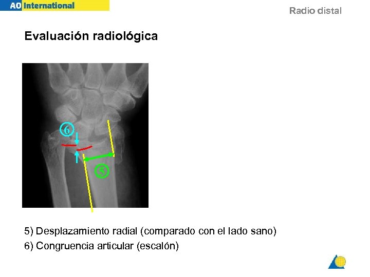 Radio distal Evaluación radiológica 6 5 5) Desplazamiento radial (comparado con el lado sano)