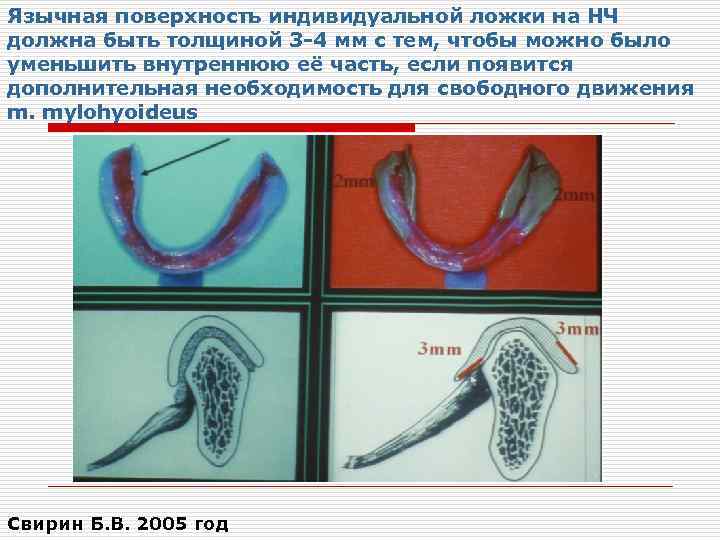 Язычная поверхность индивидуальной ложки на НЧ должна быть толщиной 3 -4 мм с тем,