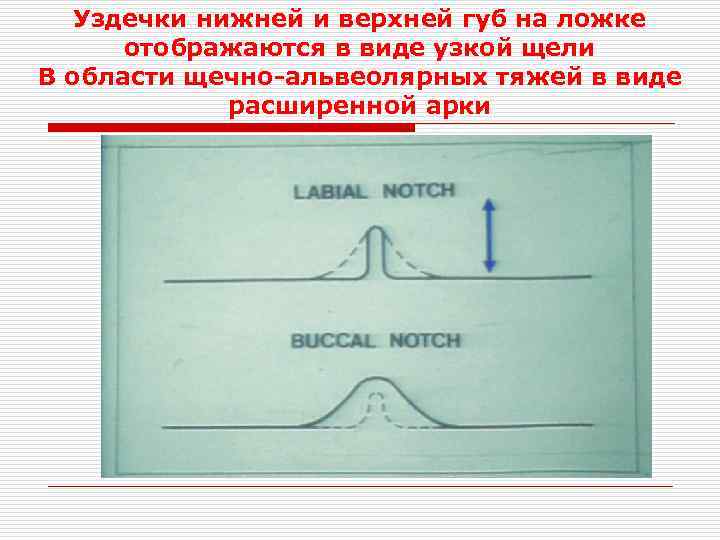Уздечки нижней и верхней губ на ложке отображаются в виде узкой щели В области