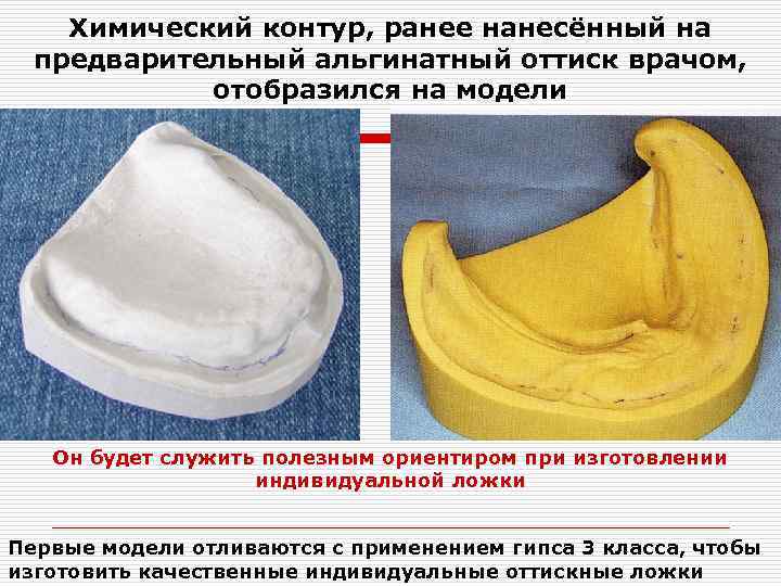 Химический контур, ранее нанесённый на предварительный альгинатный оттиск врачом, отобразился на модели Он будет