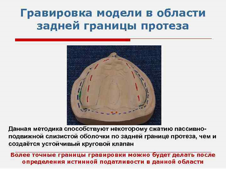 Гравировка модели в области задней границы протеза Данная методика способствуют некоторому сжатию пассивноподвижной слизистой