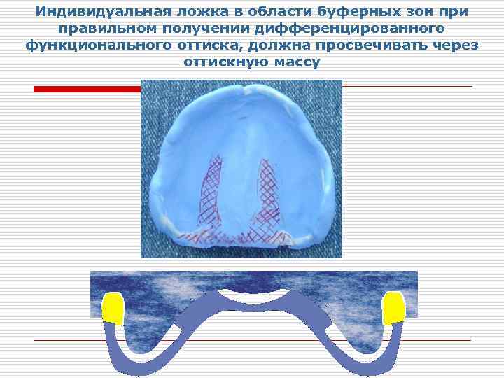 Индивидуальные ложки в ортопедической стоматологии презентация