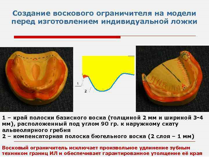Создание воскового ограничителя на модели перед изготовлением индивидуальной ложки 1 – край полоски базисного