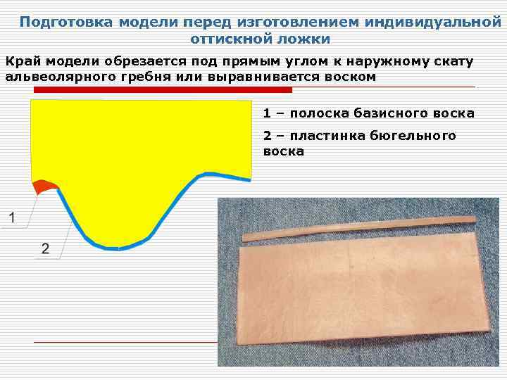 Подготовка модели перед изготовлением индивидуальной оттискной ложки Край модели обрезается под прямым углом к