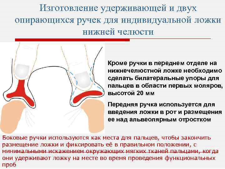 Изготовление удерживающей и двух опирающихся ручек для индивидуальной ложки нижней челюсти Кроме ручки в