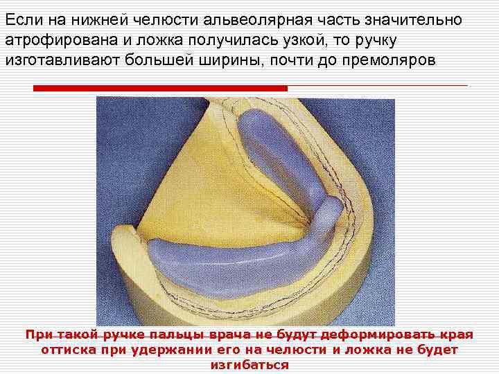 Если на нижней челюсти альвеолярная часть значительно атрофирована и ложка получилась узкой, то ручку