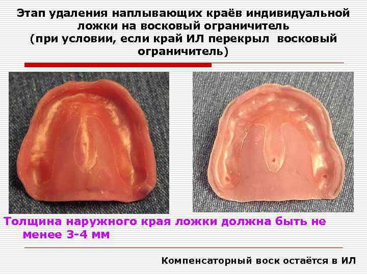 Индивидуальные ложки в ортопедической стоматологии презентация