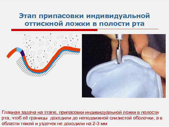 Индивидуальные ложки в ортопедической стоматологии презентация