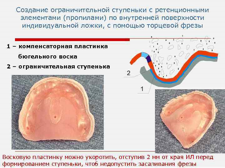 Край индивидуальный. Окантовка индивидуальной ложки. Материал для окантовки индивидуальных ложек. Ретенционные элементы. Ретенционные пропилы ложка.